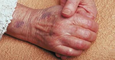 Purple Skin - Symptoms, Causes, Treatments | Healthgrades.com
